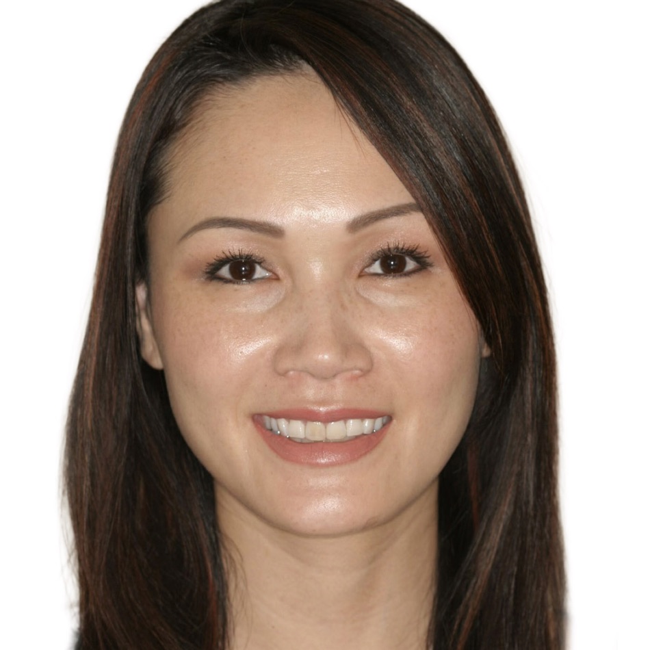 Upper & Lower Anterior Veneers & Posterior Crowns, before